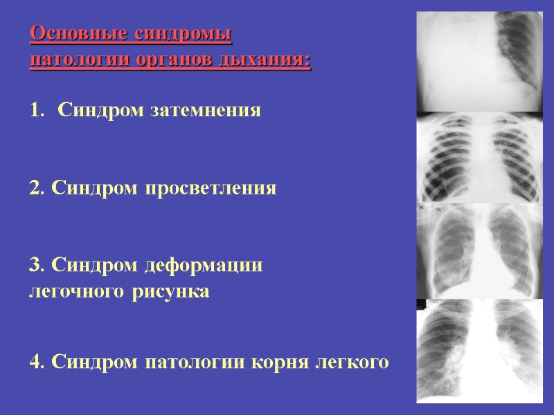 Основные синдромы  патологии органов дыхания:  Синдром затемнения   2. Синдром просветления